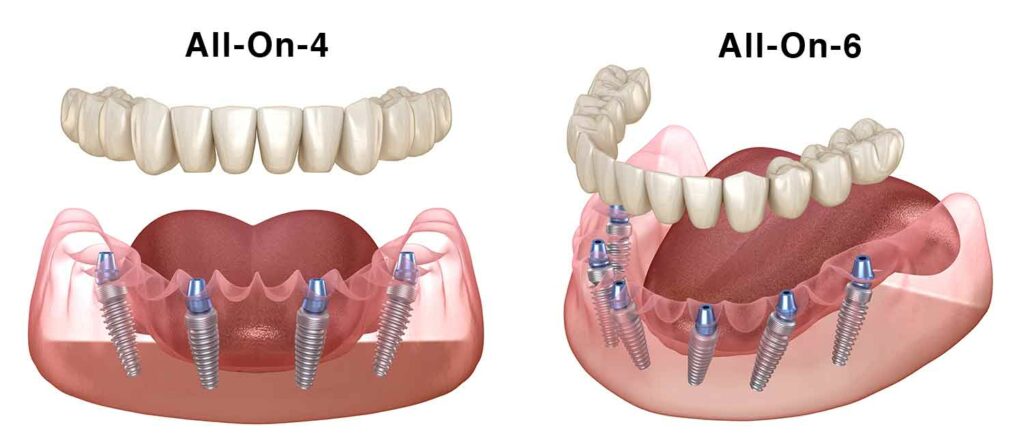 All on 4 ve All on 6 diş implantları - İstanbul'un en iyi diş hekimleri