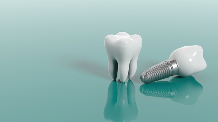 Bir günde yapılan diş implantının fiyatı ve maliyeti ne kadardır, daha mı ucuzdur, daha mı pahalıdır?