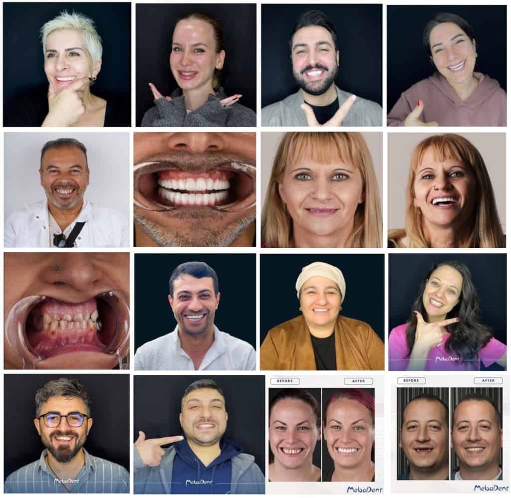 İmplant, zirkonyum kaplama ve hollywood smile tedavisi olmuş olan hastaların öncesi sonrası resimleri