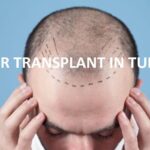 Cena transplantacije kose u Turskoj. trošak za implant kose u Istanbulu