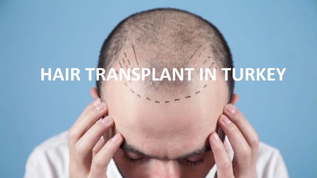Hair transplant prices in Istanbul / Turkey. What is the cost?