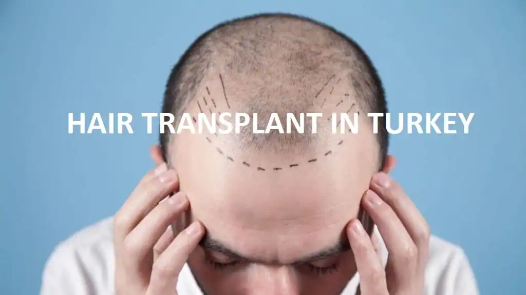 Harga transplantasi rambut di Turki. Berapa harga transplantasi rambut di Istanbul?